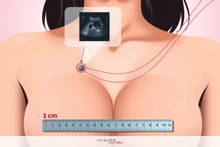 How Big Are Breast Cancer Lumps?