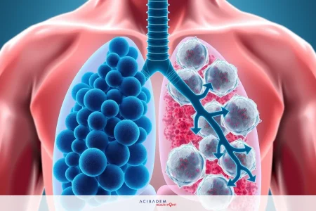 What is the difference between small cell and non- small cell lung cancer?